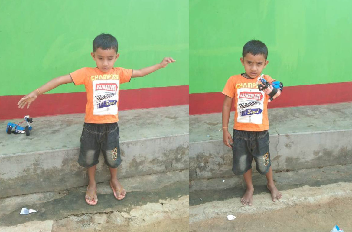 मुख्यमंत्री श्री बघेल द्वारा शुरू किये गए फिजियोथेरेपी तुमचो दुवार से मिला नया जीवन